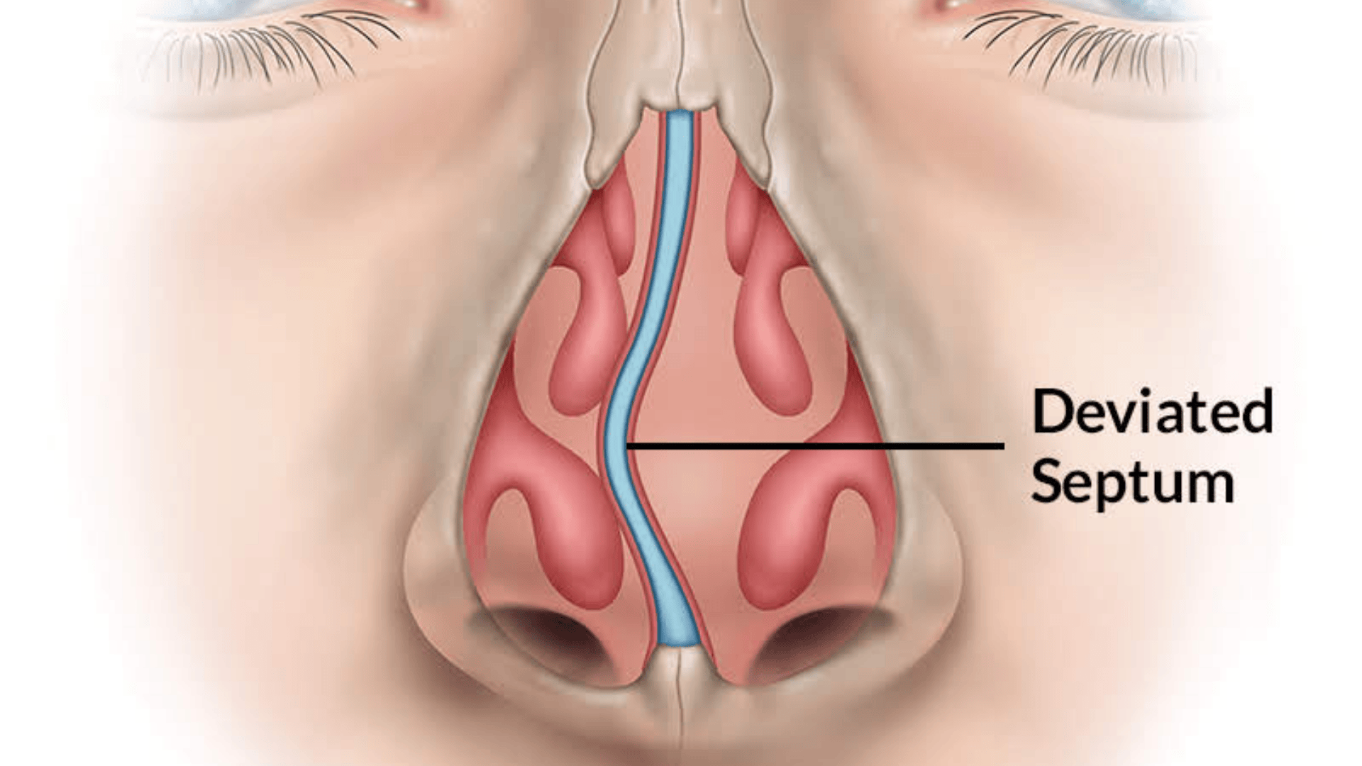 _can-a-deviated-septum-cause-sleep-apnea