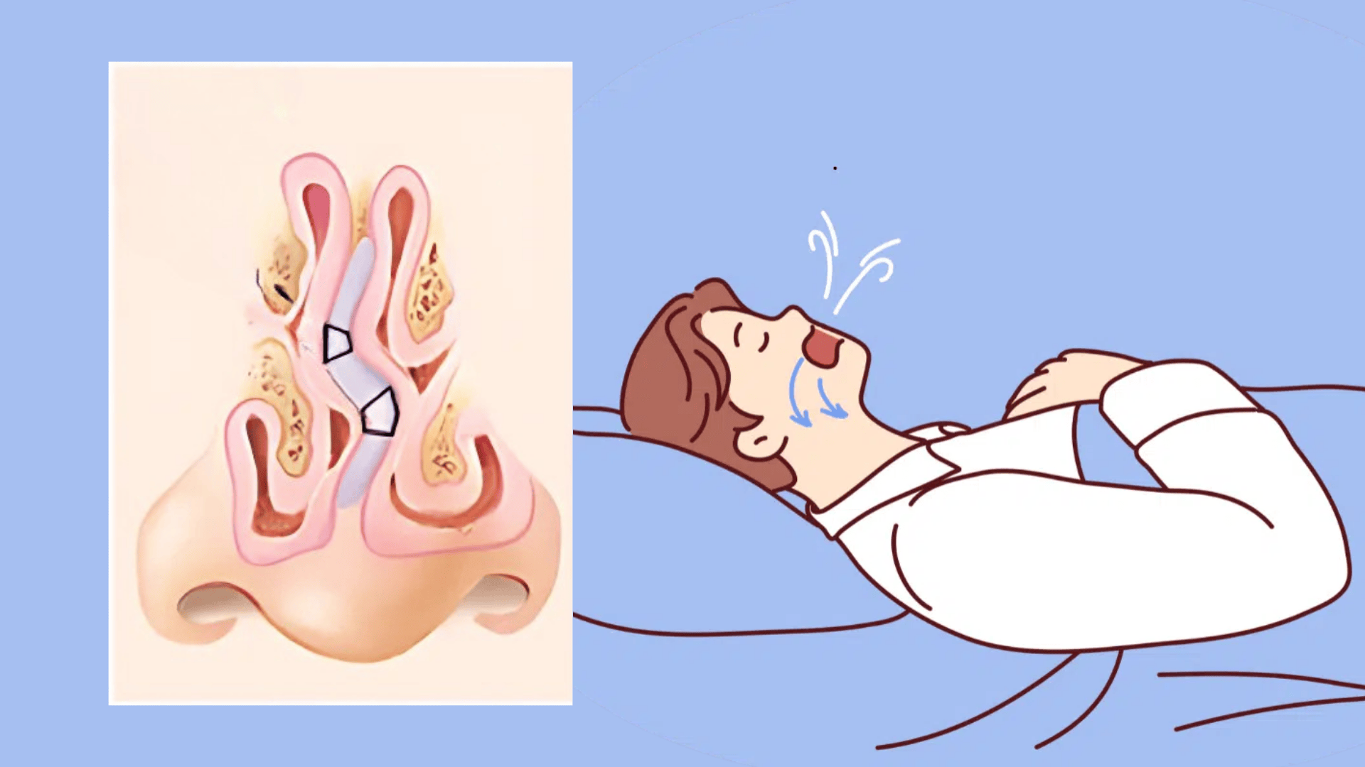 _can-a-deviated-septum-cause-sleep-apnea+(2)